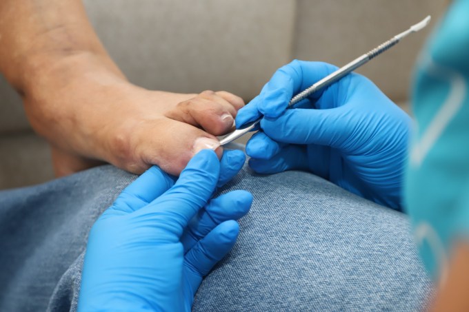 Juanetes, pie plano y dolor de talón son las principales causas de consulta podológica en Castilla y León. La biomecánica y la prevención, claves para evitar lesiones.